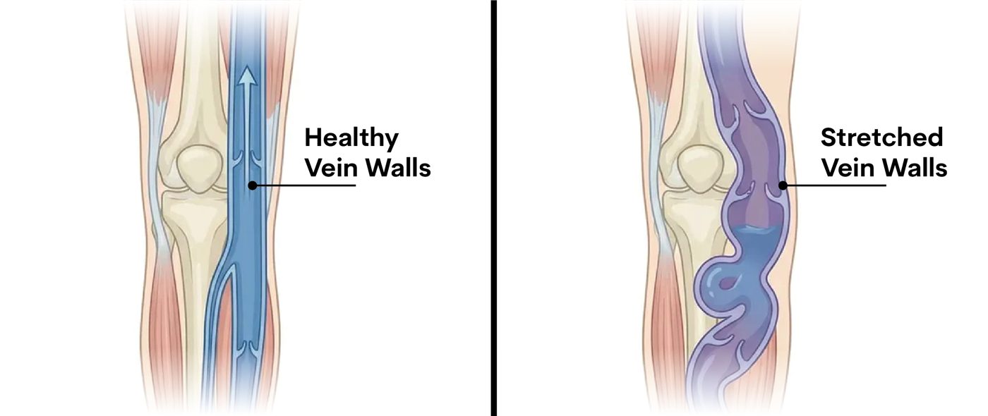Healthy vein wall compared to a stretched vein wall
